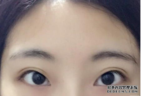 什么是間歇性外斜視，需要治療嗎